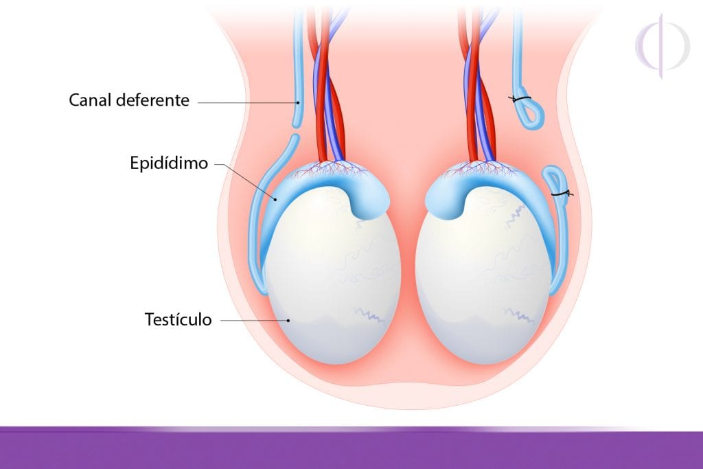 Revers O Da Vasectomia Cl Nica Reproduce