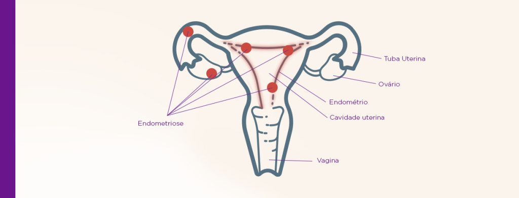 Endometriose Endometriose profunda e infertilidade qual a relação