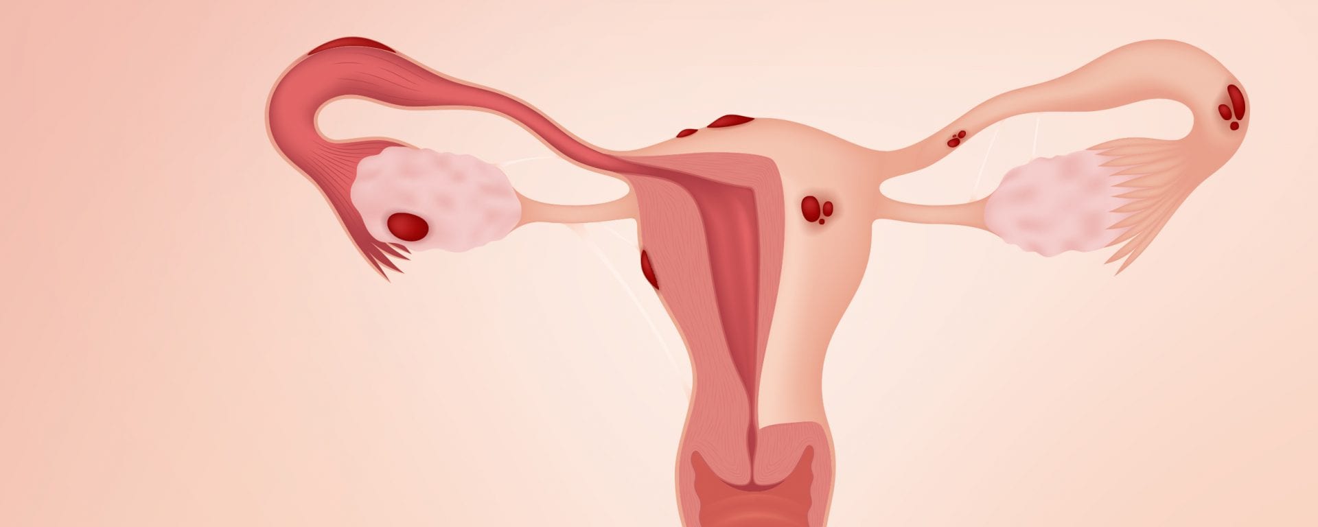 Menstruação retrógrada: saiba o que é e qual doença ela pode causar