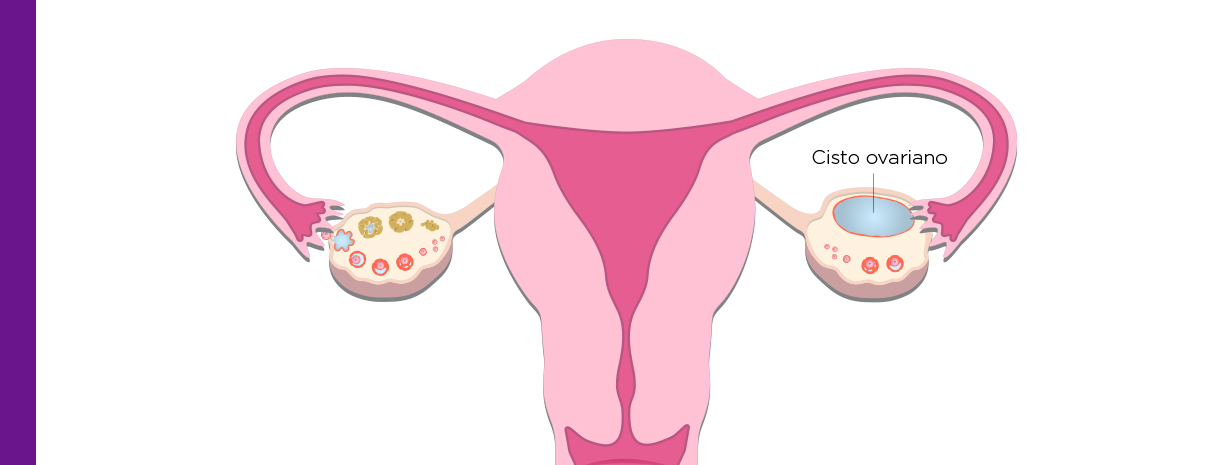 Endometriomas: o que são? - Art Fértil