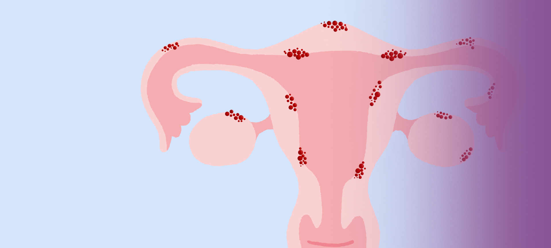 Endometriose Como é Feito O Tratamento Clínica Reproduce 3362