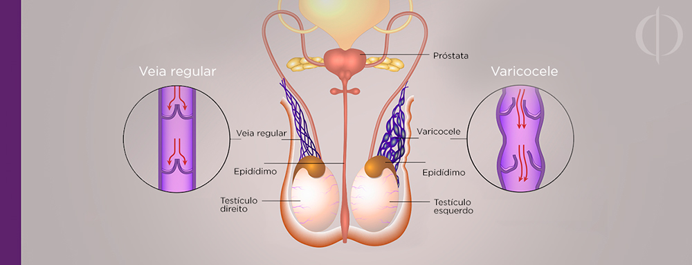 Prostatitis és varicocel Prosztatile prosztataárral