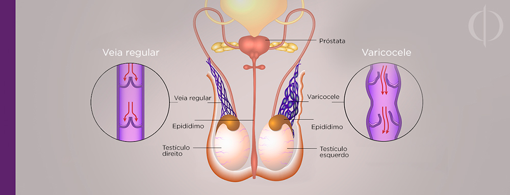 venele varicoase reticulare i hormoni)