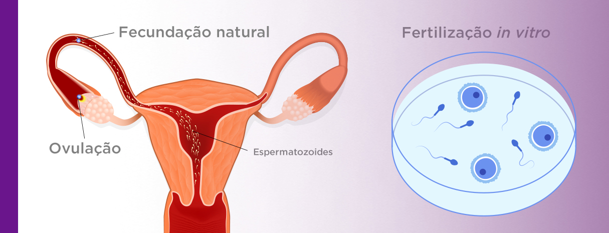 Como Ocorre A Fecundação Natural E Na Fiv Clínica Reproduce 